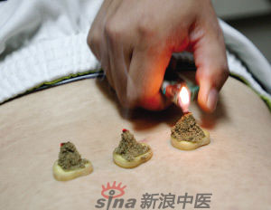 灸法的種類  你知道多少？